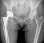 hip replacement surgery in kolkata